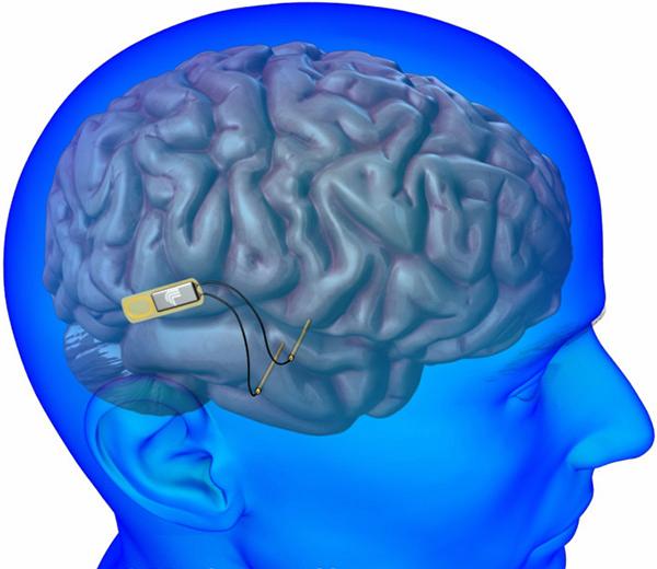 Neuralink
