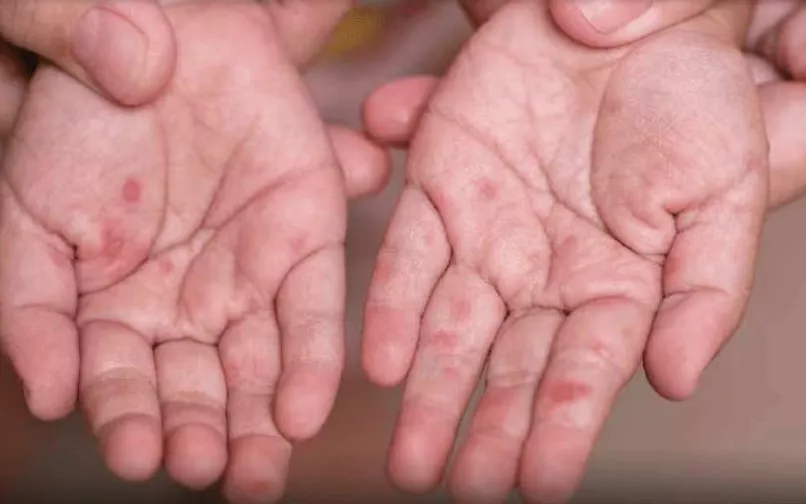 Afectación por virus Coxsackie o Enterovirus A71