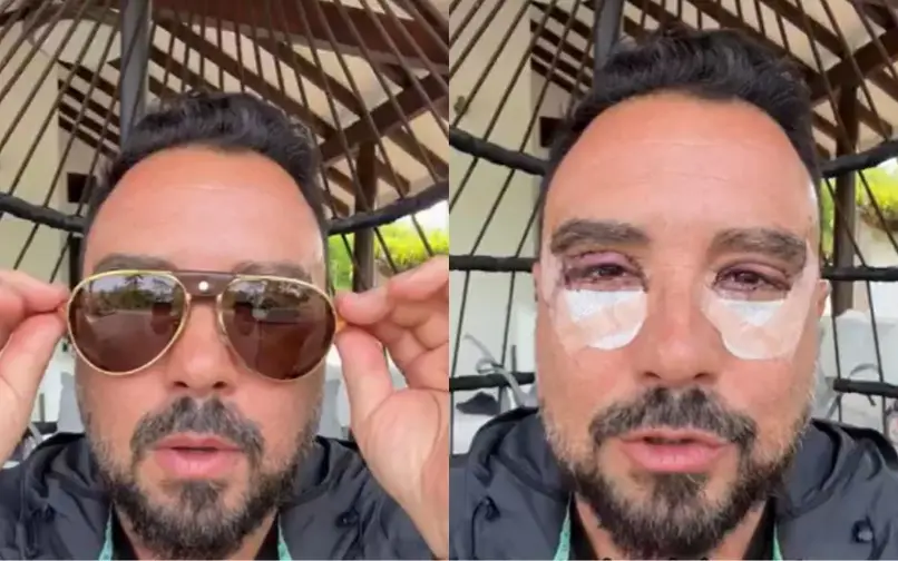 Tulio Zuloaga se sometió a una blefaroplastia