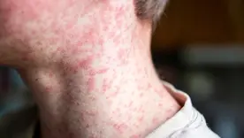 Persona con Sarampión