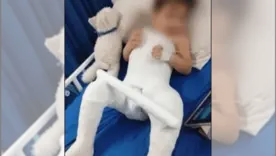 Niño de dos años con fractura 