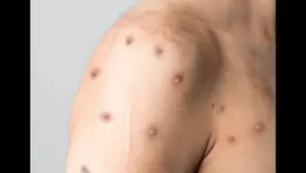 Mpox