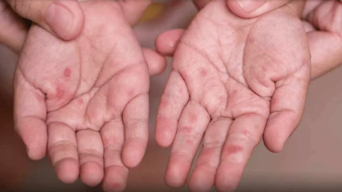 Afectación por virus Coxsackie o Enterovirus A71