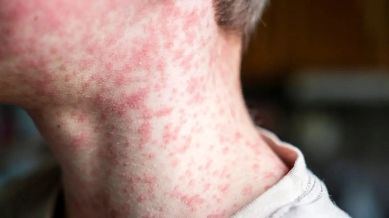 Persona con Sarampión