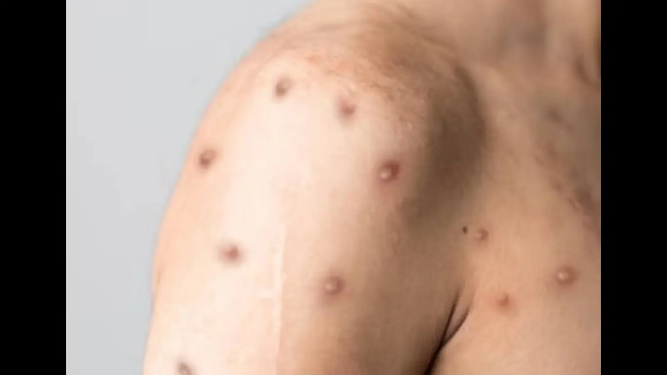Mpox