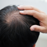Tratamiento para la calvicie