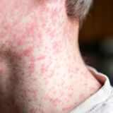 Persona con Sarampión
